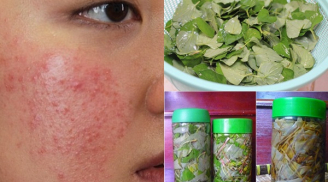 Da mụn chi chít, đen sạm sẽ bật tông trắng hồng chỉ nhờ 1 nắm diếp cá và rượu trắng nhà nhà đều có