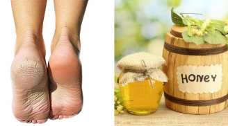 7 mẹo chữa nứt gót chân, chảy máu hiệu quả nhất