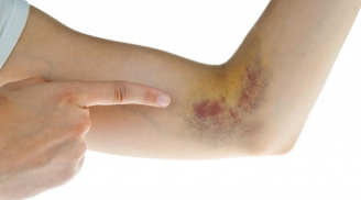 Dấu hiệu nhận biết bệnh máu khó đông
