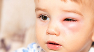 Bệnh đau mắt ở trẻ em và cách cha mẹ cần biết để phòng tránh