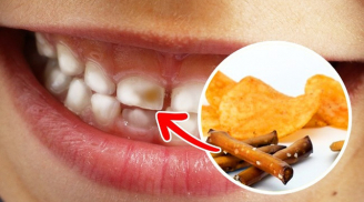 7 thực phẩm gây hại cho răng bạn nhất định phải tránh xa nếu không muốn mình bị 'kém duyên'
