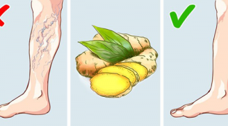 12 phương pháp tự nhiên chữa giãn tĩnh mạch ở chân hiệu quả tại nhà