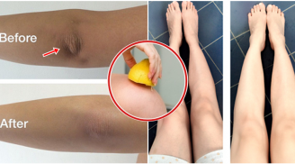 6 công thức 'thần thánh' giúp bạn hóa phép đầu gối thâm đen thành trắng sáng
