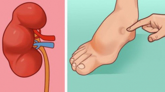 Bạn có thuộc nhóm 7 người dễ bị đột quỵ nhất dưới đây không?