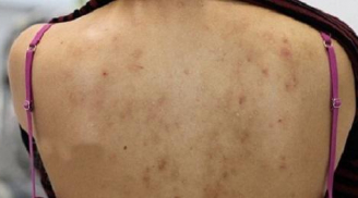 Những cách trị mụn lưng bằng nguyên liệu thiên nhiên hiệu quả nhất