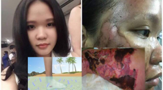 Cô gái người Anh nhiễm vi khuẩn ăn thịt người, đáng chú ý căn bệnh ghê gợn này từng xuất hiện ở Việt Nam