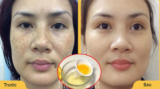 'Đánh bay' vết nám da cứng đầu lâu năm với nguyên liệu cực rẻ mà lại dễ tìm