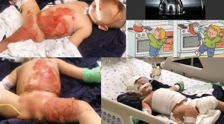 Em bé 20 tháng bị bỏng nguy kịch vì vật dụng nhà nào cũng có