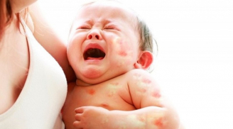 Dấu hiệu nguy hiểm cho thấy trẻ bị dị ứng sữa cha mẹ hết sức chú ý kẻo quá muộn