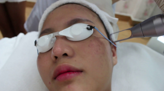 Những nguyên tắc sống còn khi trị nám bằng laser mà ai cũng phải 'khắc cốt ghi tâm'
