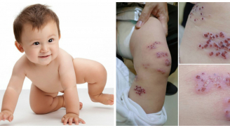 Bé 1 tuổi nổi mụn nước chi chít vô cùng đáng sợ, sự thật đằng sau khiến ai cũng bất ngờ