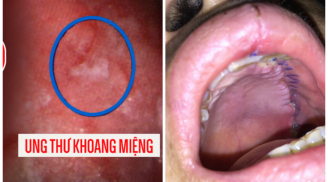 Nghiện món triệu quý ông mê, người đàn ông Hà Nội phải nạo nửa mặt vì ung thư tấn công