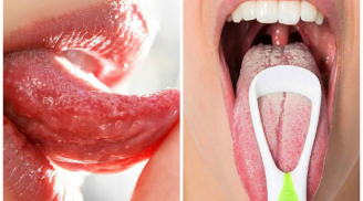 Nhìn vào lưỡi 5 giây: Thấy có màu này cảnh báo bệnh ung thư, viêm phế quản nặng. Hãy đi gặp bác sĩ ngay!