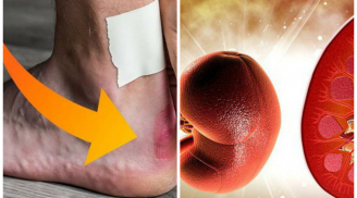 Bàn chân có đủ 3 ba dấu hiệu sau nhanh đi khám thận gấp, cẩn thận sắp chạy thận cả đời