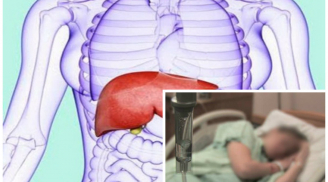 Cảnh báo từ vụ: Giám đốc 40 tuổi bị ung thư gan vì làm 4 việc trong thời gian dài