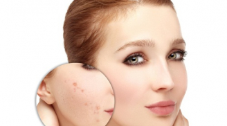 Trị sẹo thâm lõm bằng các nguyên liệu cực kỳ đơn giản, dễ kiếm