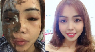 Cuồng ghen, cựu Thiếu úy Công an thẳng tay tạt axit vào vợ sắp cưới gây thương tích