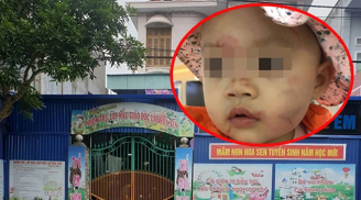 Bé gái 14 tháng tuổi thâm tím mặt sau buổi học đầu tiên: Thông tin chính thức từ công an