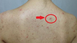 Thấy lưng mọc nhiều mụn, hãy cảnh giác với lời 'báo động đỏ' từ cơ thể