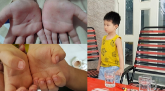 Cô giáo mầm non dùng vật nhọn đâm vào tay bé trai 5 tuổi?