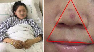 Cảnh báo từ vụ: Bé 12 tuổi nguy kịch vì nặn mụn ở mũi, lưu ý vùng tam giác nguy hiểm trên mặt