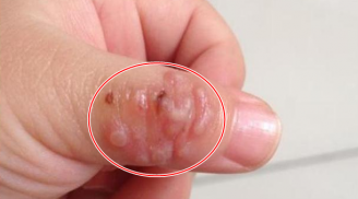 Ngón tay cái của bé gái bị phồng rộp: Không ngờ nguyên nhân đến từ thói quen đứa trẻ nào cũng thích