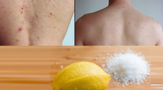 3 cách trị mụn lưng cấp tốc, hiệu quả cao tại nhà mà bạn gái nào cũng nên biết