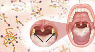 Liên tiếp xuất hiện ổ bệnh bạch hầu: Nguy hiểm thế nào và cách phòng ngừa?