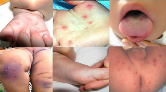 Muốn bảo vệ con thoát bệnh tay chân miệng, cha mẹ nhất định phải biết những điều này