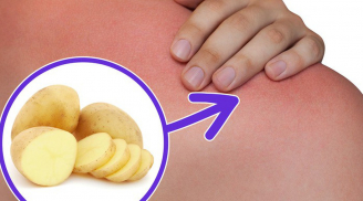 Lỡ bị bỏng, hãy cắt ngay một khoanh khoai tây đắp lên sẽ xảy ra điều kỳ diệu
