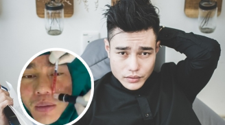 Lê Dương Bảo Lâm hé lộ sự cố 'dao kéo' đáng sợ, đến bạn thân nhìn vào còn tưởng đã chết