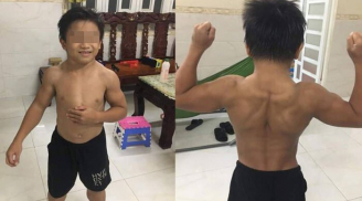 Cậu bé 10 tuổi cơ bắp cuồn cuộn dù không hề tập luyện do mắc hội chứng hiếm gặp