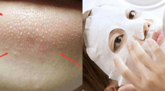 Kém xinh vì cằm dày đặc và toàn hạt trắng, chỉ với 3 bước này, tất cả đều sạch bong