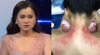 Lâm Vỹ Dạ đăng hình ảnh tấm lưng đầy mẩn đỏ kèm dòng trạng thái bị người xấu làm hại