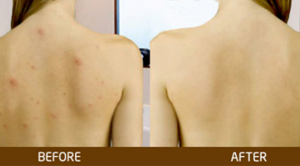 Trị sạch mụn lưng trong vòng '1 nốt nhạc' với bột đậu đỏ