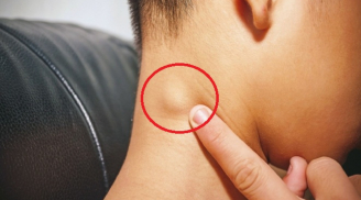 3 dấu hiệu ở cổ cảnh báo khối u ở tuyến giáp: Dù chỉ có 1 biểu hiện cũng phải đi khám gấp