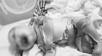 Lại thêm 1 bé sơ sinh mắc bệnh vảy cá, da toàn thân nứt từng mảng trắng