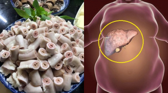 5 thực phẩm phá nát lá gan nhanh hơn bia rượu, toàn món quen thuộc trên mâm cơm của người Việt