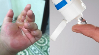 2 loại thuốc nên có trong nhà đề phòng trường hợp con nhỏ bị bỏng, mẹ nhất định phải biết