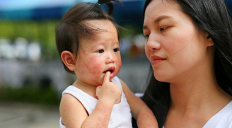 Hè về, bố mẹ cần biết ngay những loại bệnh này để giúp con phòng tránh
