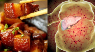 4 thực phẩm màu trắng khiến gan nhàu nát nhưng nhà nào cũng có