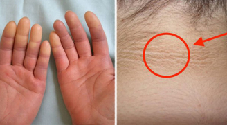 7 dấu hiệu trên da báo hiệu bệnh tiểu đường, thấy nổi mụn bất thường hãy cảnh giác