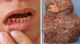 4 dấu hiệu trên miệng cảnh báo lá gan bị tổn thương nghiêm trọng