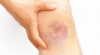Trên da thường xuất hiện vết bầm tím là bệnh gì?