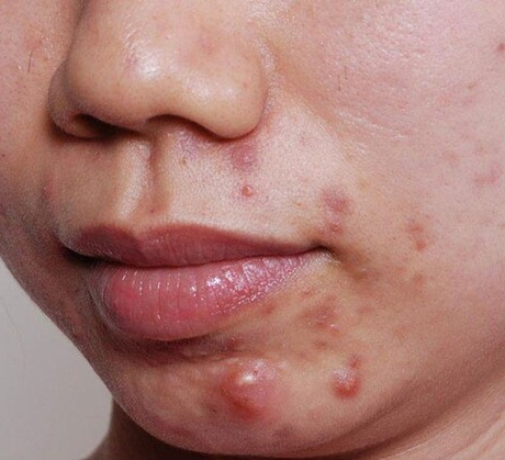 Đã có cách cho các teen muốn quẳng gánh u sầu vì mụn quanh năm